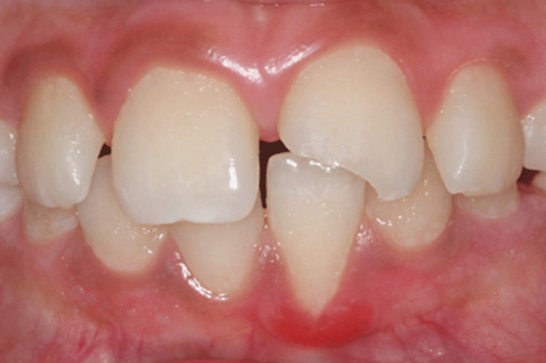 Zahnfraktur Zahn 21